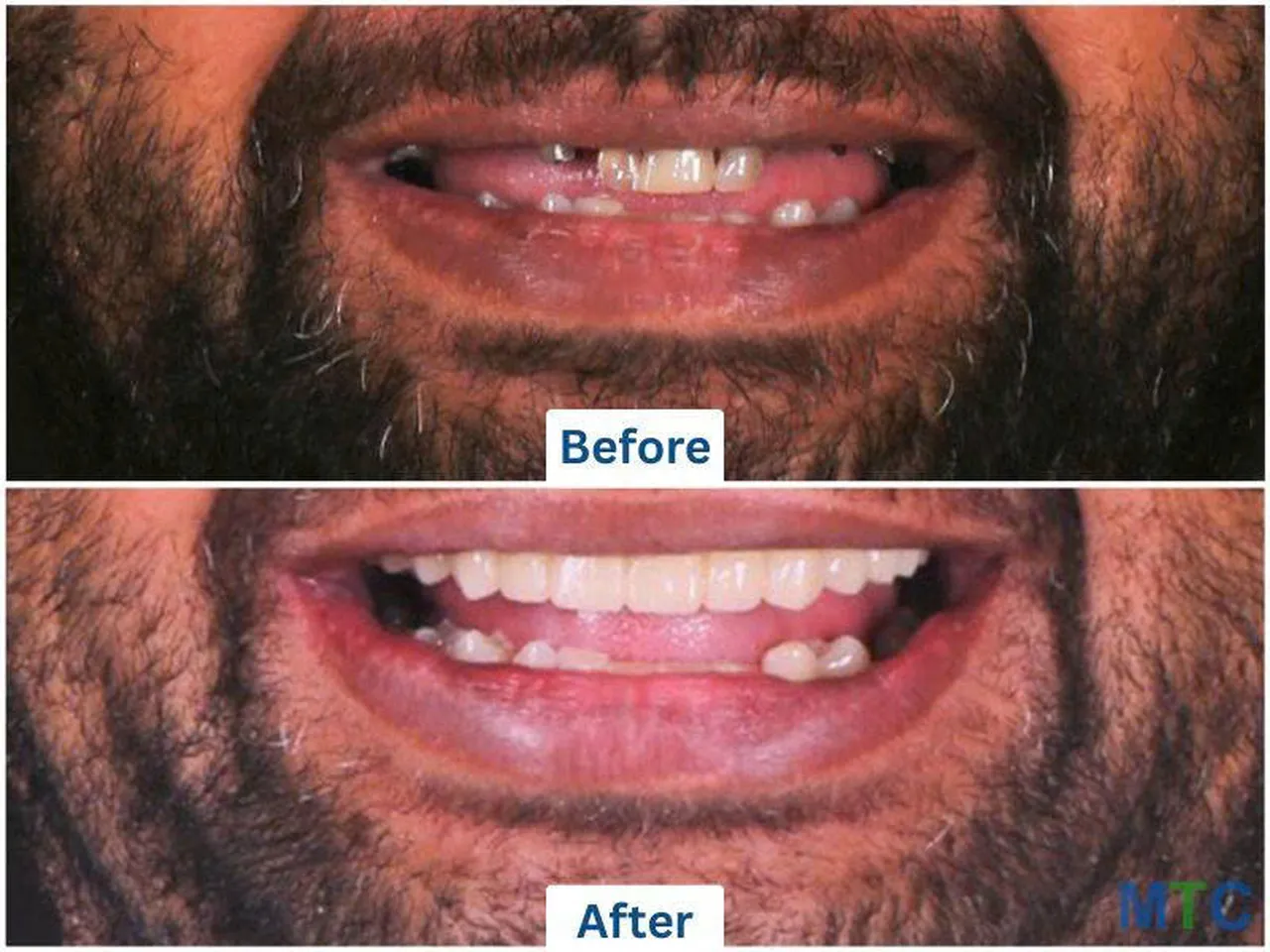  Image of a multiple teeth restoration by Doctor Care implant clinic number 1 