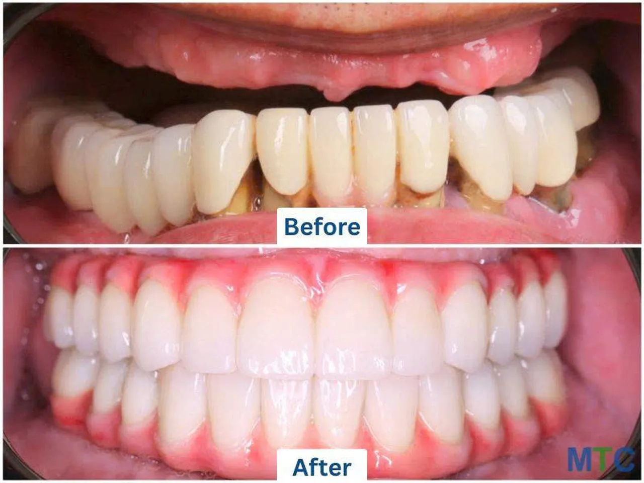  Infographics of insertion of an implant post in a patient's jaw 