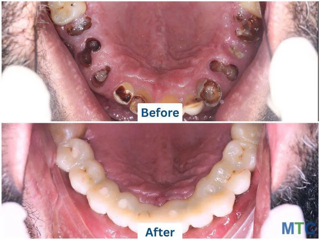  Image of a multiple teeth restoration by Doctor Care implant clinic number 3 