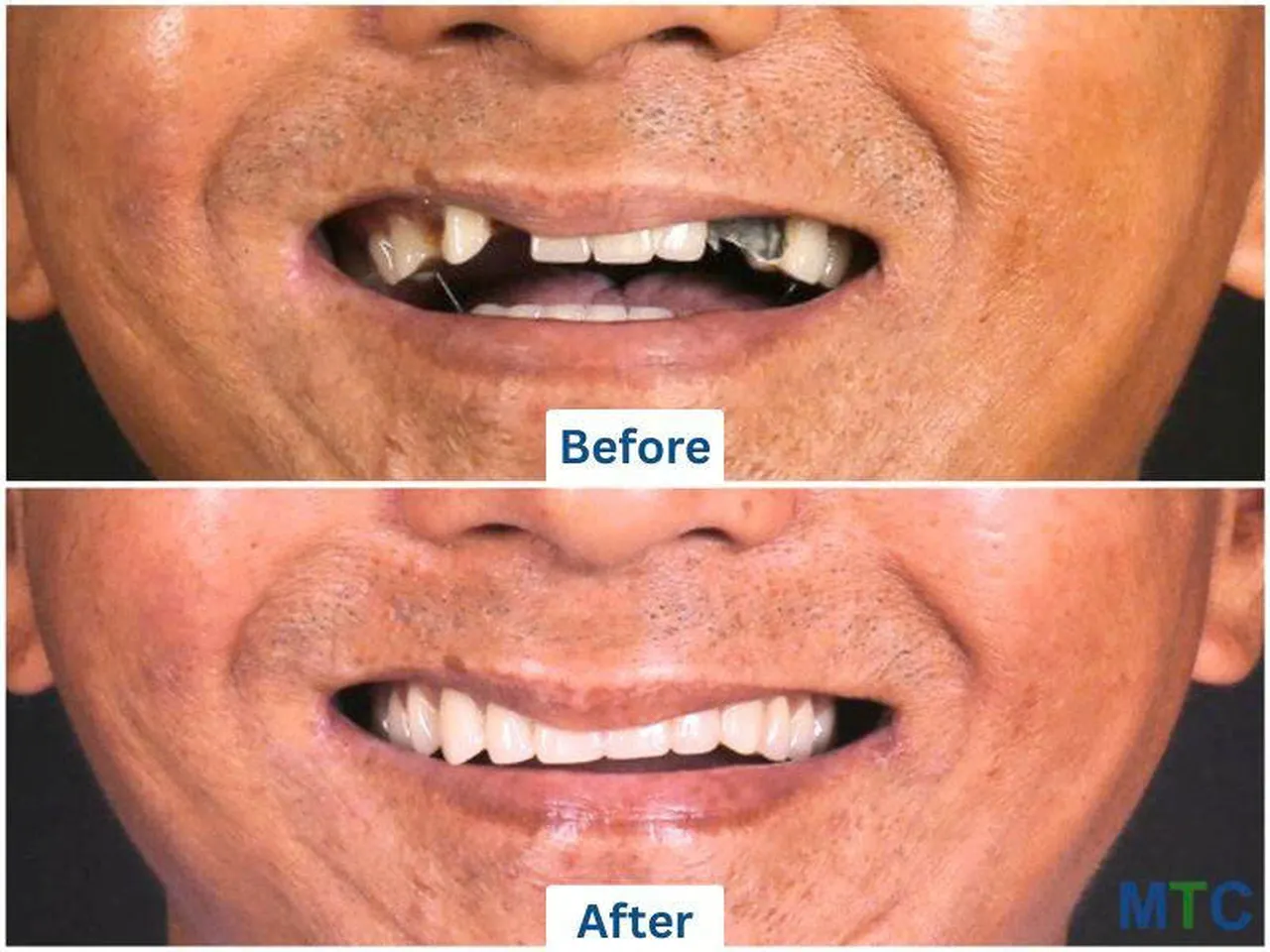  Image of a multiple teeth restoration by Doctor Care implant clinic number 4 
