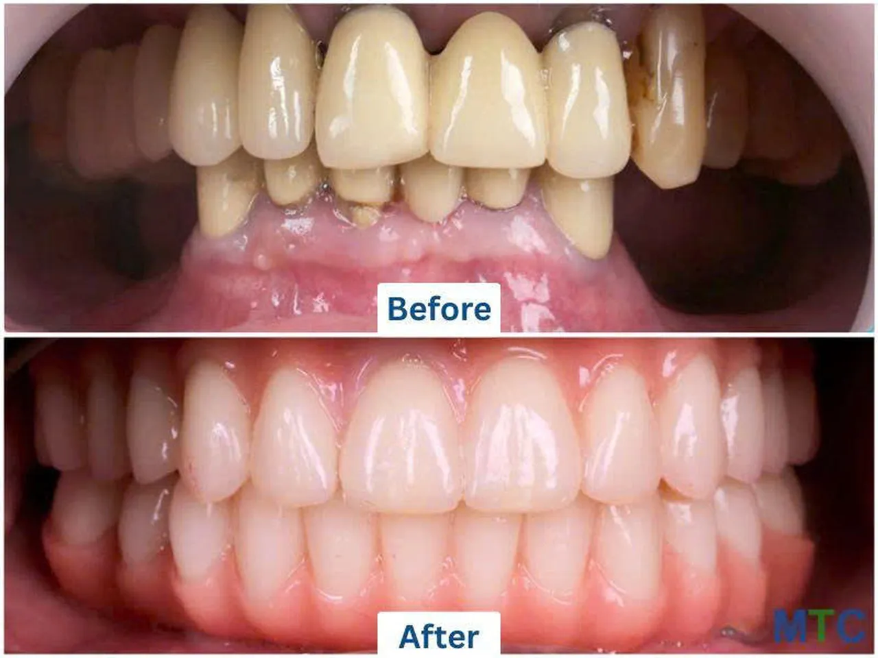  Image of a multiple teeth restoration by Doctor Care implant clinic number 5 