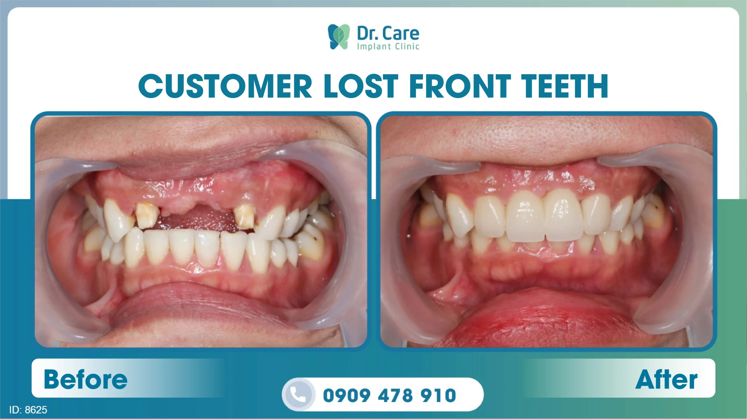  Before and after image of a patient's teeth after single implant procedure 