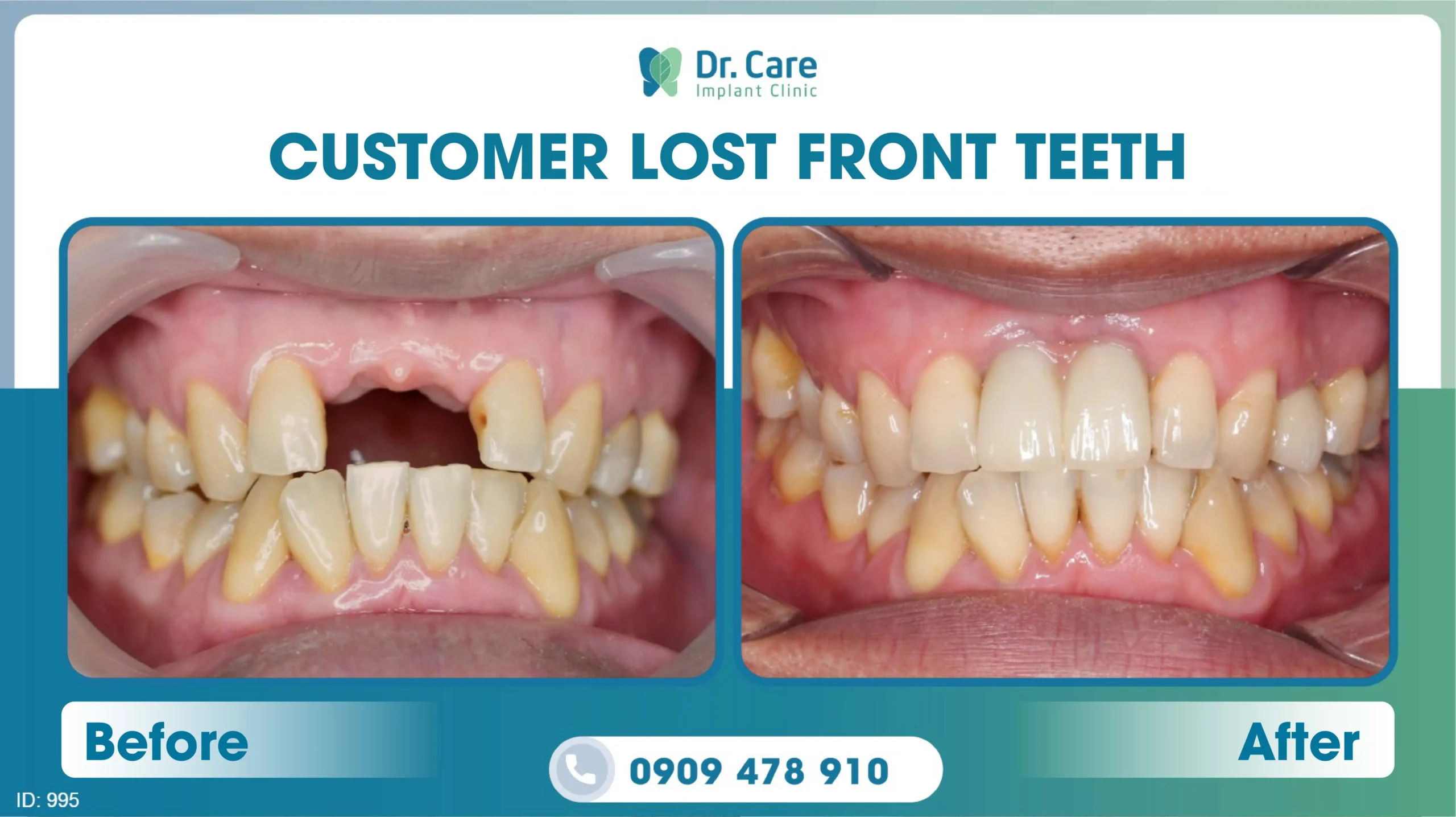  Before and after image of a patient's teeth after single implant procedure number 2 