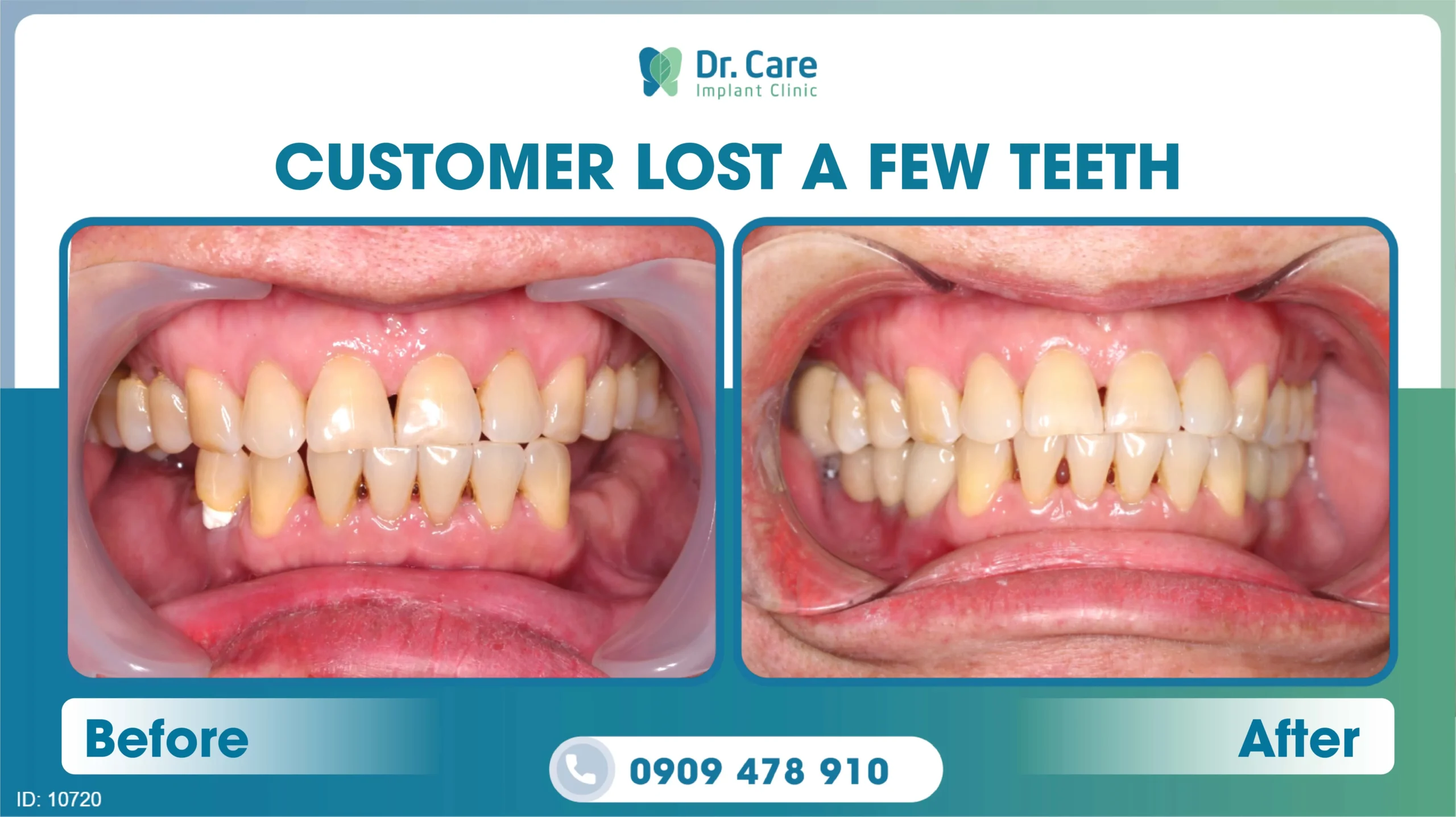  Before and after image of a patient's teeth after single implant procedure number 3 