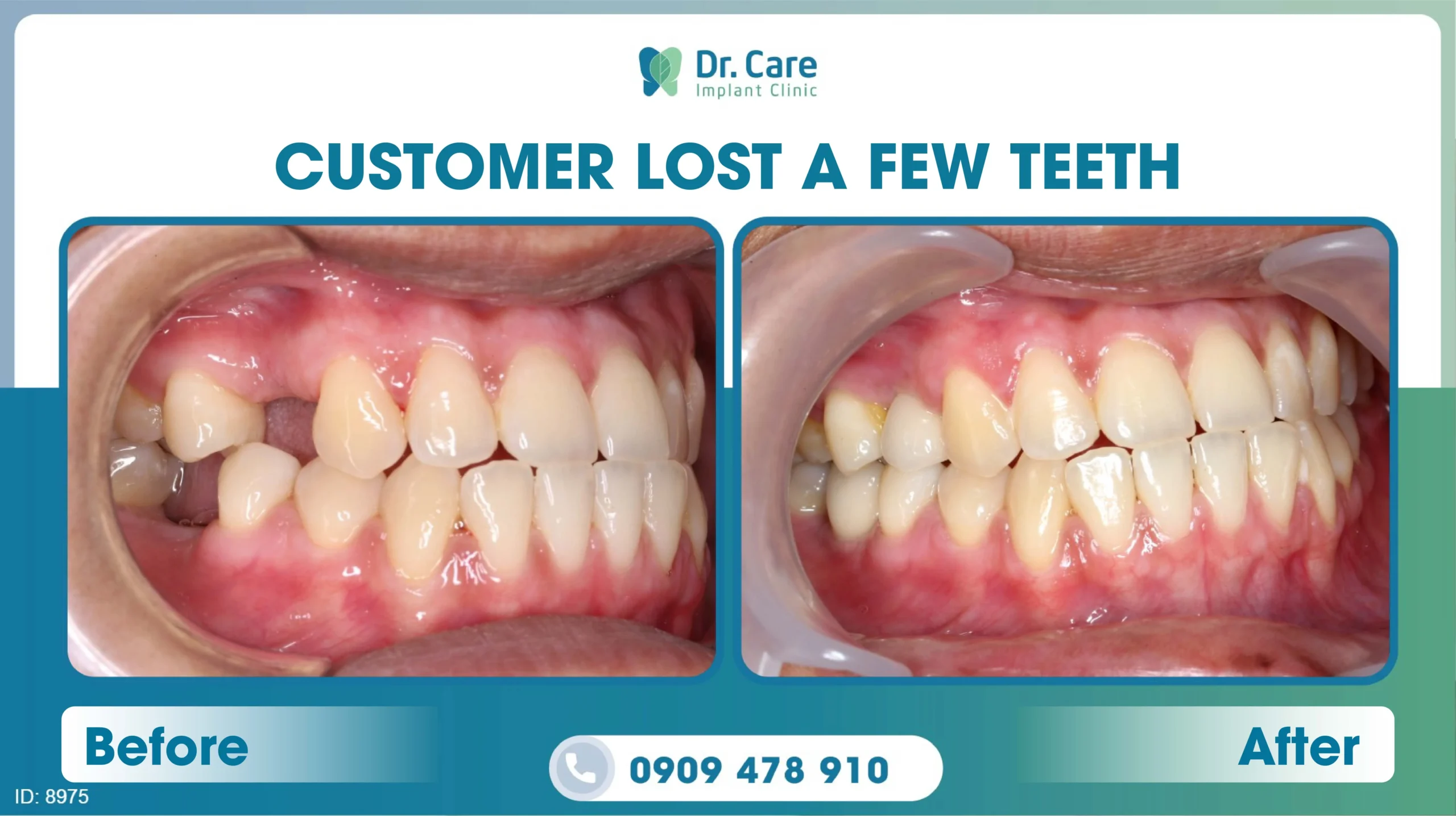  Before and after image of a patient's teeth after single implant procedure number 4 