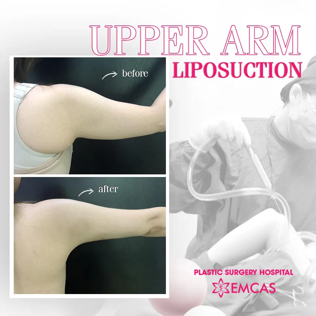  image of a patient during abdominal liposuction surgery at EMCAS Cosmetic Surgery Hospital in Vietnam 