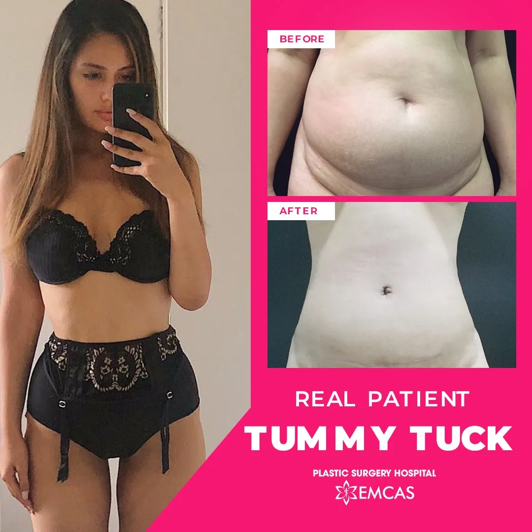  Before and After image of a person who underwent visceral fat liposuction (tummy tuck) at EMCAS Cosmetic Surgery Hospital in Vietnam 