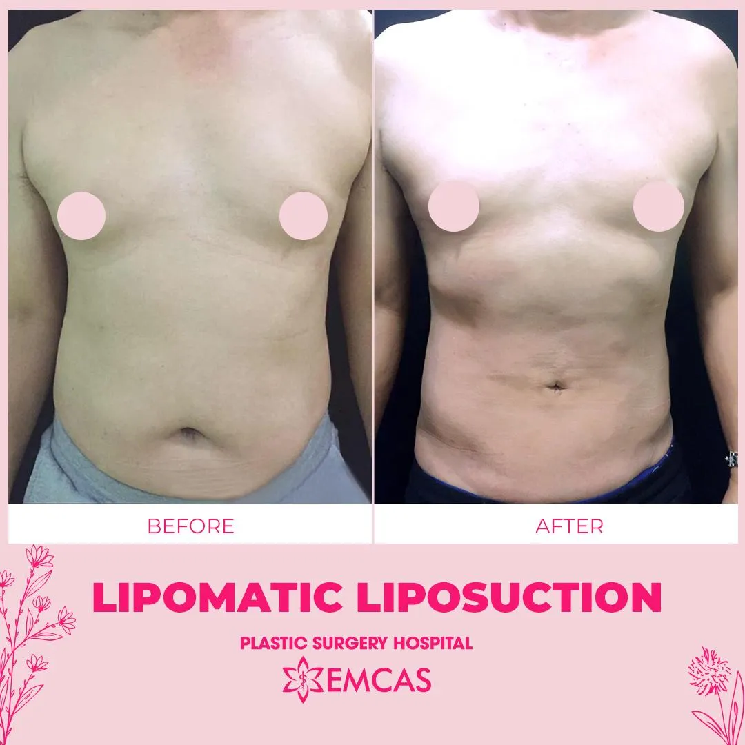  image of a patient during abdominal liposuction surgery at EMCAS Cosmetic Surgery Hospital in Vietnam 