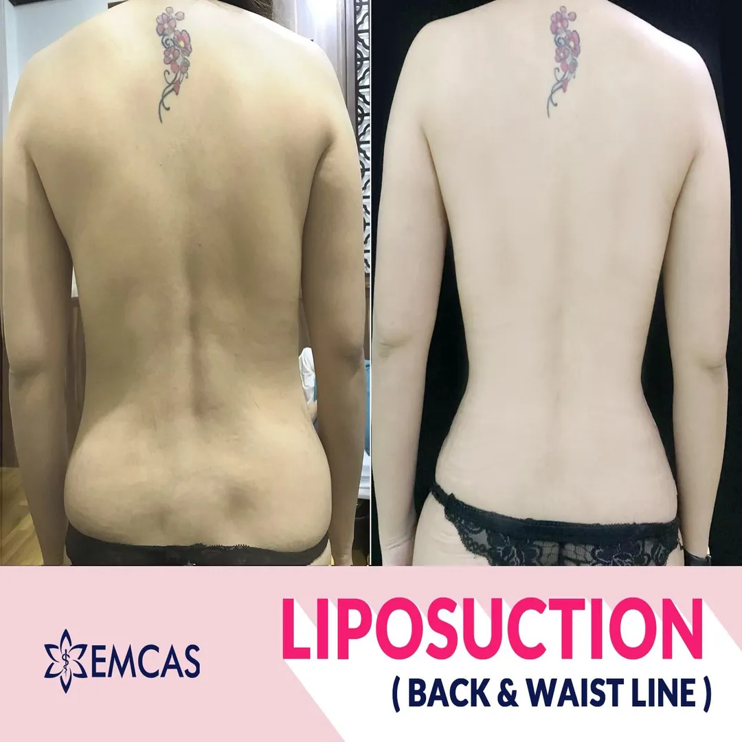  image of a patient during abdominal liposuction surgery at EMCAS Cosmetic Surgery Hospital in Vietnam 