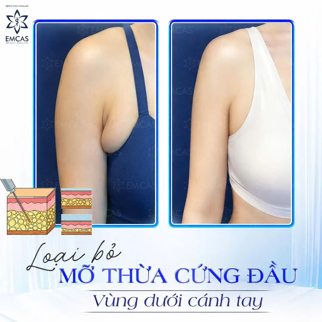  Before and after image of a patient's teeth after single implant procedure number 2 