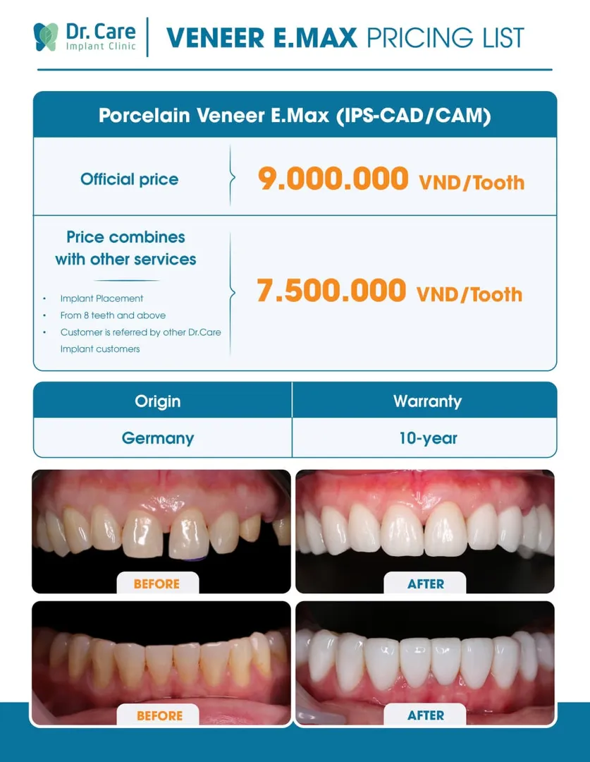 Price guide for E.max veneers available for patients in Dr. Care Implant Clinic in Ho Chi Minh City, a popular medical and dental travel destination in Vietnam in 2026