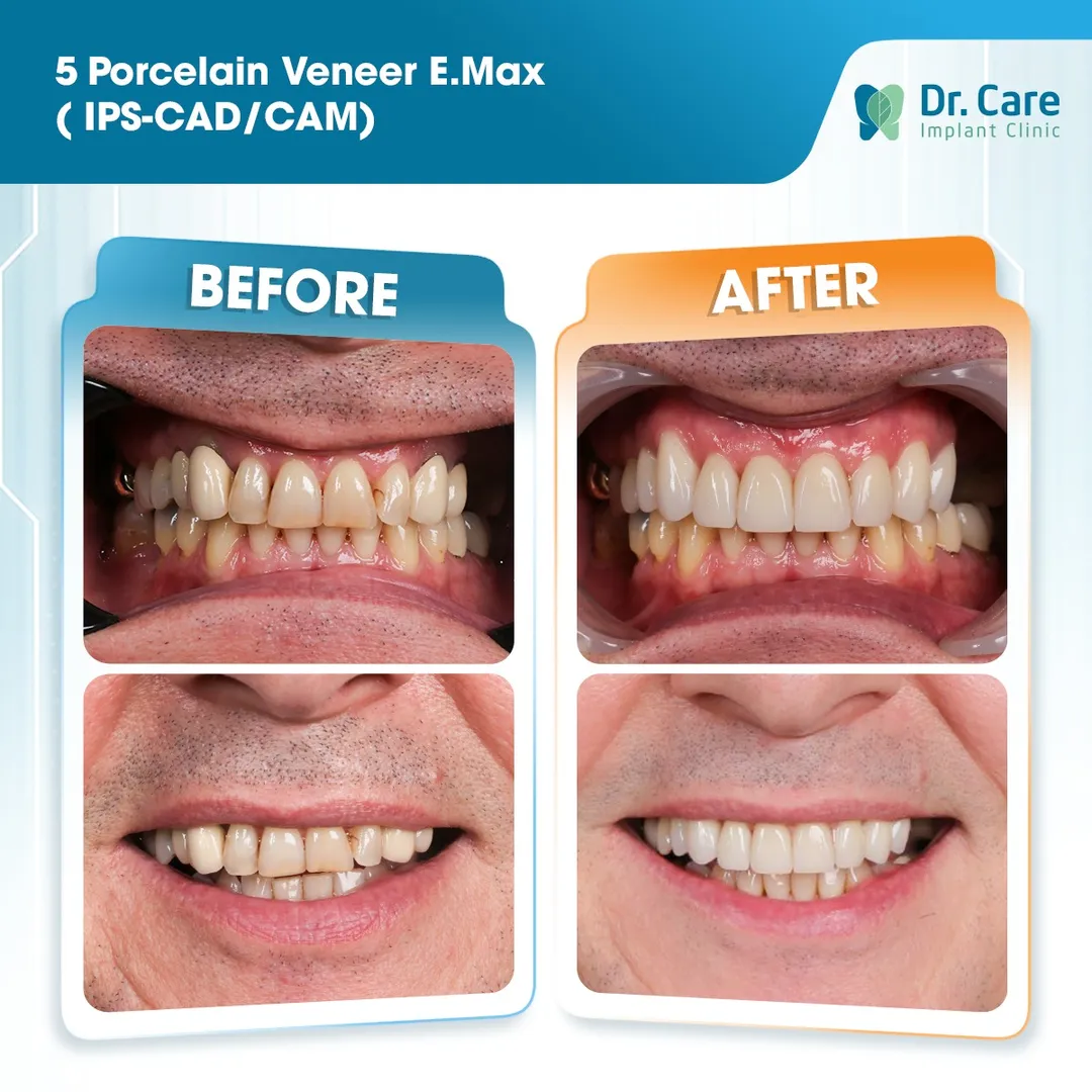  Before and after images of 5 porcelain veneers fitted to the patient's teeth using E.max. IPS CAD/CAM technology at Dr .Care  Implant Clinic in Ho Chi Minh City in Vietnam, a popular medical and travel destination in 2026 