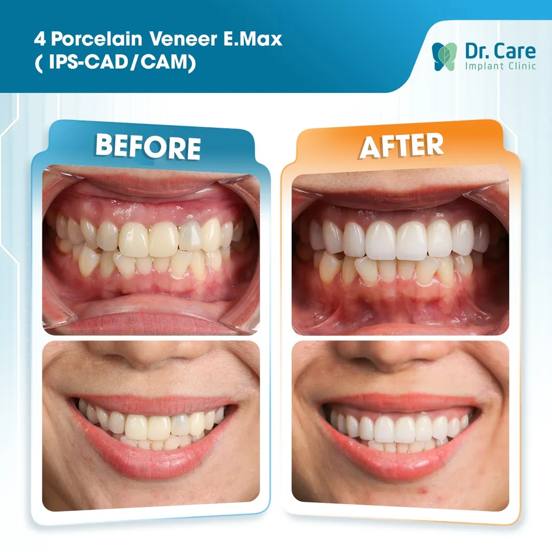  Before and after images of 4 porcelain veneers fitted to the patient's teeth using E.max. IPS CAD/CAM technology at Dr .Care  Implant Clinic in Ho Chi Minh City in Vietnam, a popular medical and travel destination in 2026 
