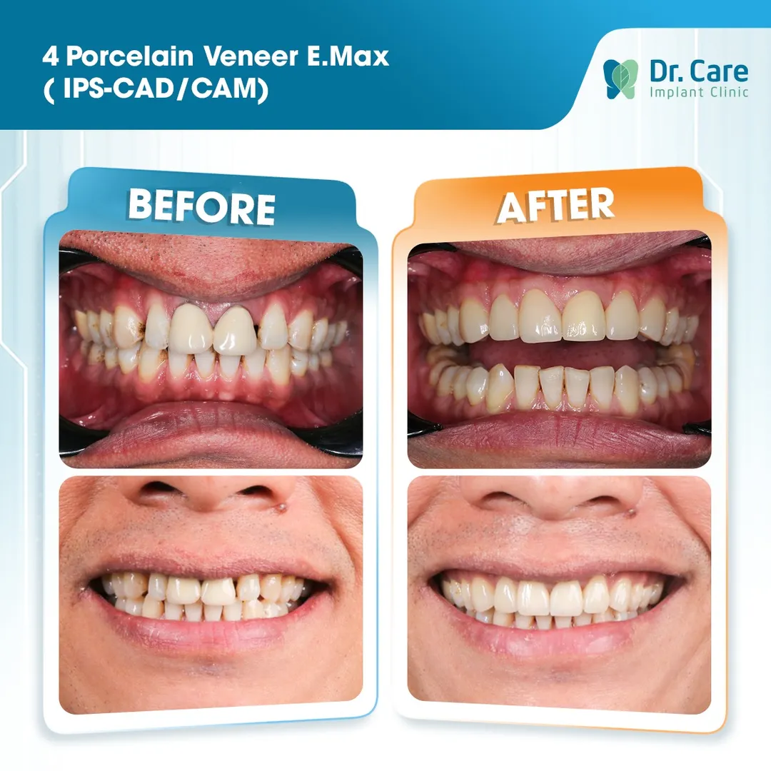  Before and after images of 4 porcelain veneers fitted to the patient's teeth using E.max. IPS CAD/CAM technology at Dr .Care  Implant Clinic in Ho Chi Minh City in Vietnam, a popular medical and travel destination in 2026 