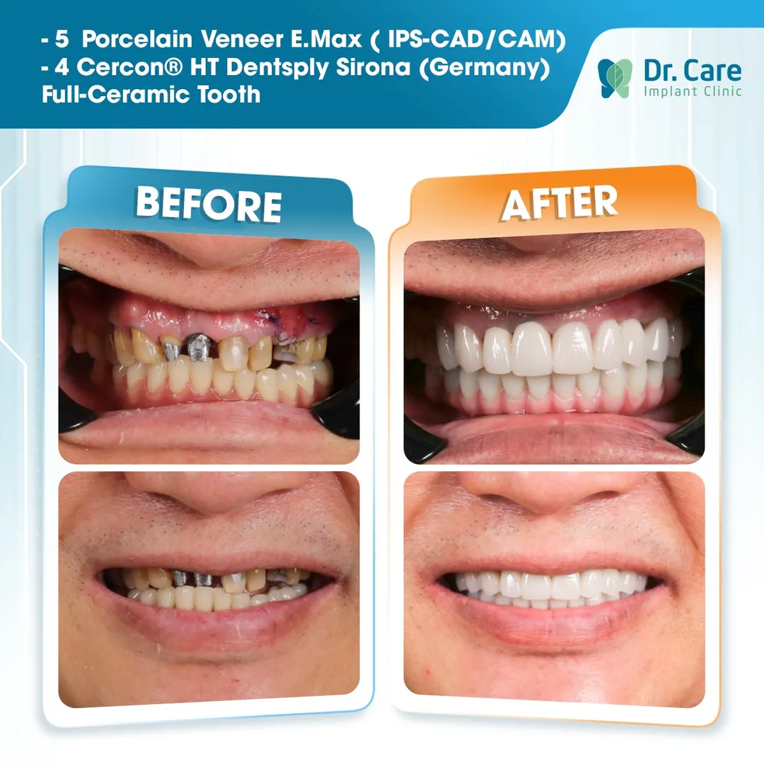  Before and after images of 5 porcelain veneers and 4 full ceramic teeth fitted to the patient's teeth using E.max. IPS CAD/CAM technology at Dr .Care Implant Clinic in Ho Chi Minh City in Vietnam, a popular medical and travel destination in 2026 