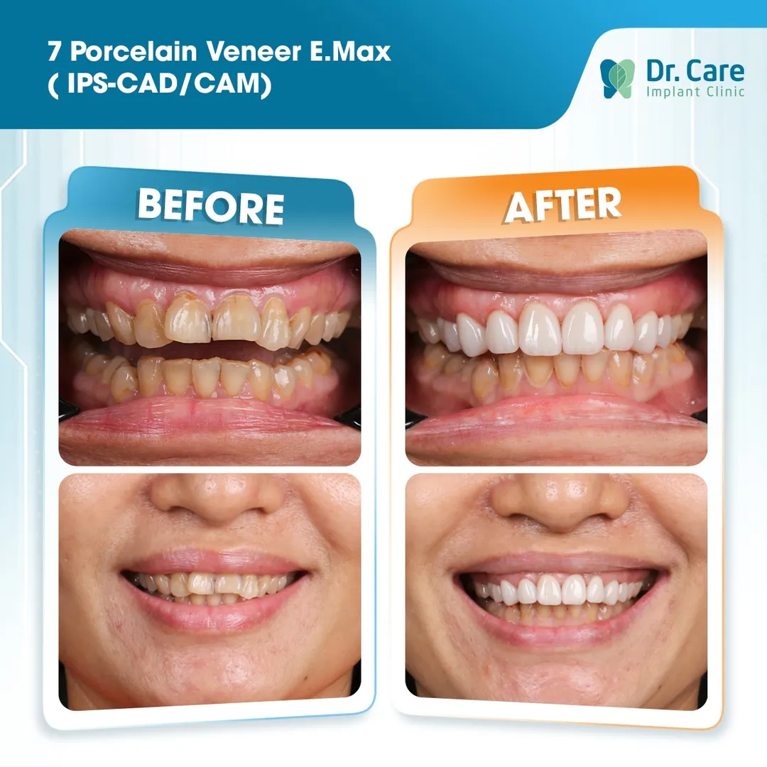  Before and after image of a patient's teeth after single implant procedure number 4 
