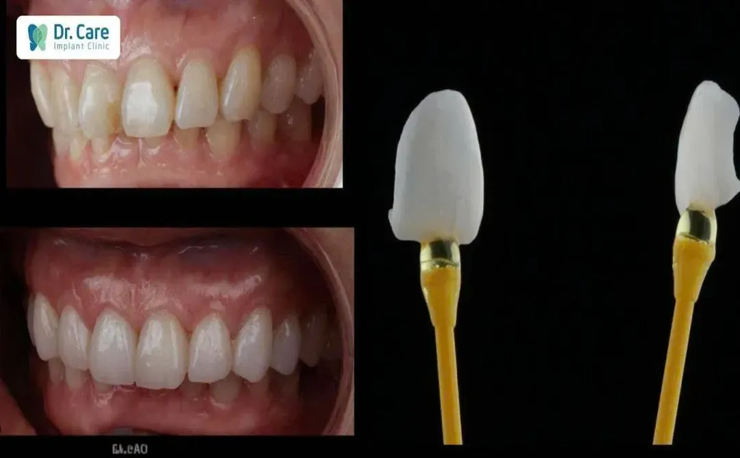 before and after image of a patient who was fitted with porcelain e.max veneers at doctor care implant clinic at ho chi mingh city in Vietnam, a popular medical travel destination in 2026