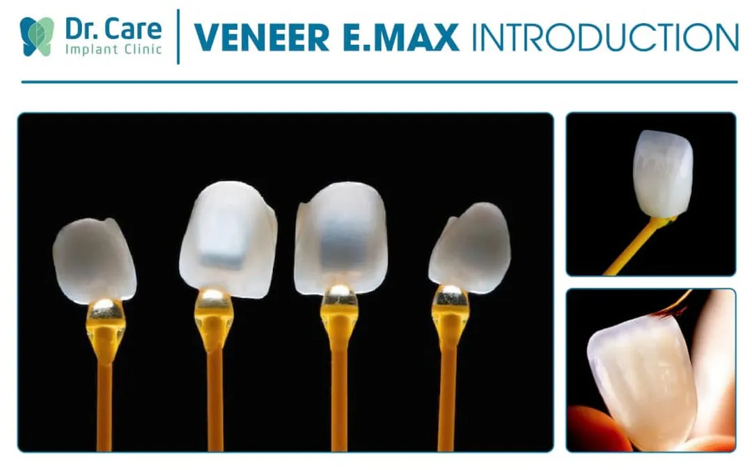 infographics of porcelain E.max veneers used at Doctor Care in Ho Chi Minh City, a popular medical travel destination in Vietnam in 2026