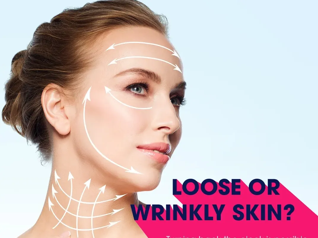 Image of a female model with suggestions to cosmetically improve loose face skin performed in Ho Chi Minh City, a popular destination for medical and dental tourism